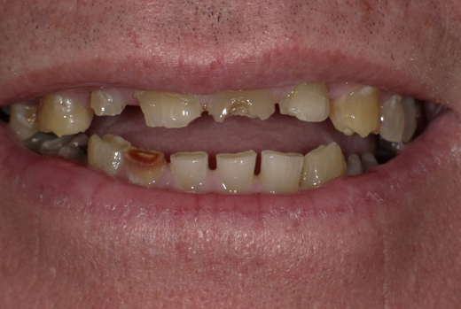 Close-up of severely damaged and decayed teeth showing gaps and discoloration requiring dental treatment.