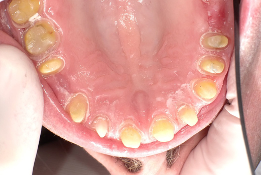 Close-up of oral cavity showing natural teeth arrangement and pink gum tissue in dental examination setting.