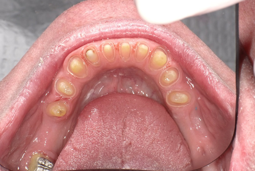 Upper dental arch showing full set of teeth during intraoral examination in clinical setting.