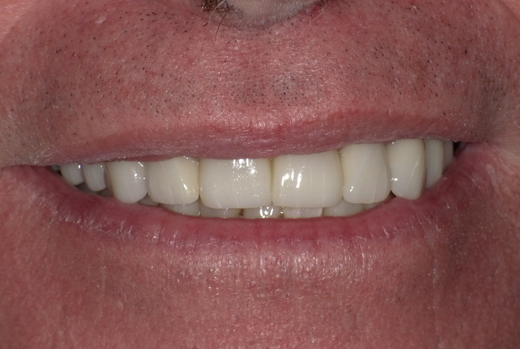 Close-up of upper teeth showing dental crown work and natural tooth alignment after treatment.