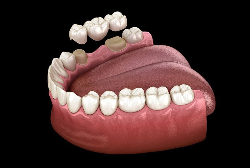 3D dental model showing implant-supported bridge with missing teeth restoration and crown placement.