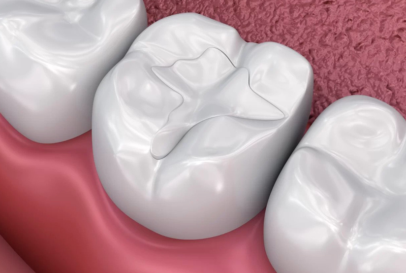 Dental crown illustration showing white porcelain tooth restoration on pink gum background.